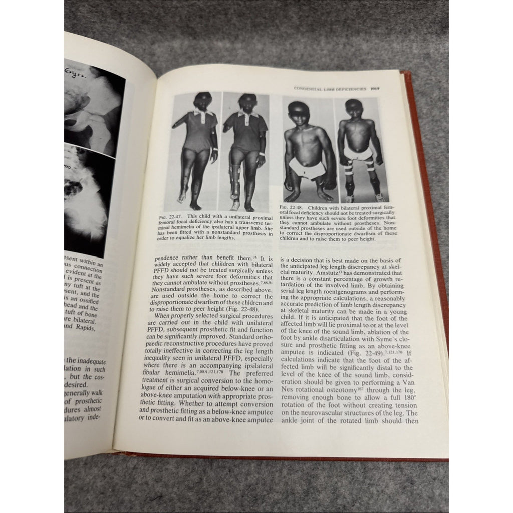 Pediatric Orthopaedics Vol. 2 by Lovell, Wood W.; Winter, Robert B.