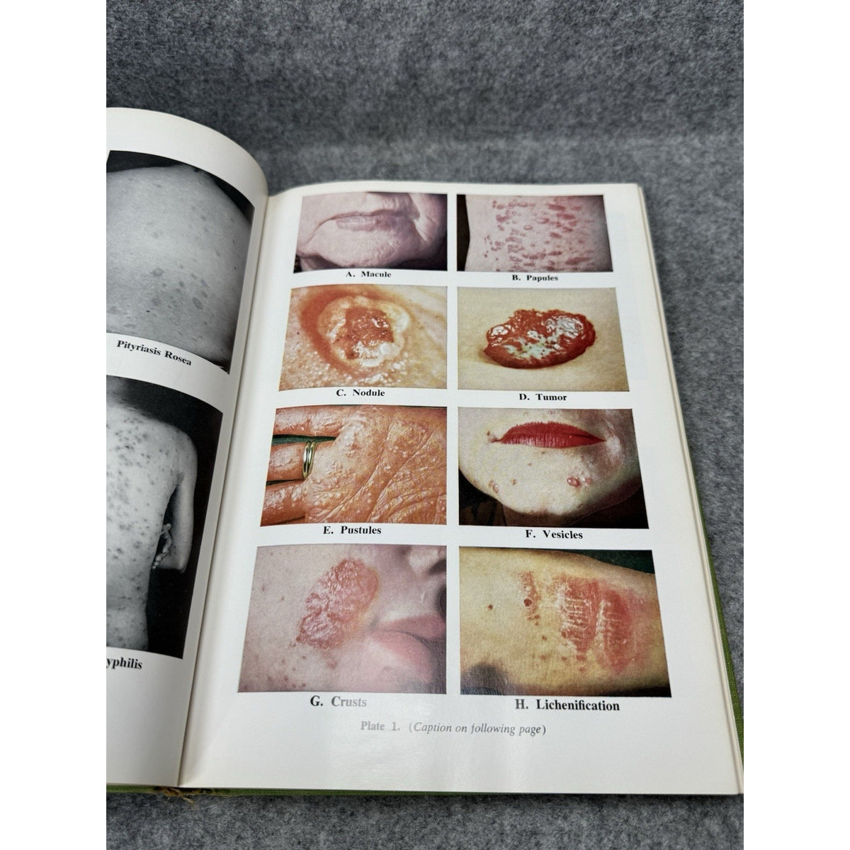 1959 Manual of Skin Diseases Gordon C Sauer Vintage Medical Illustrated HC