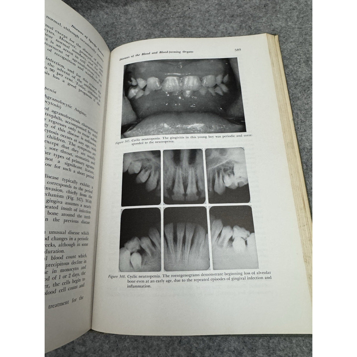 1958 A Textbook of Oral Pathology Shafer Hine Levy HC Illustrated Dentistry